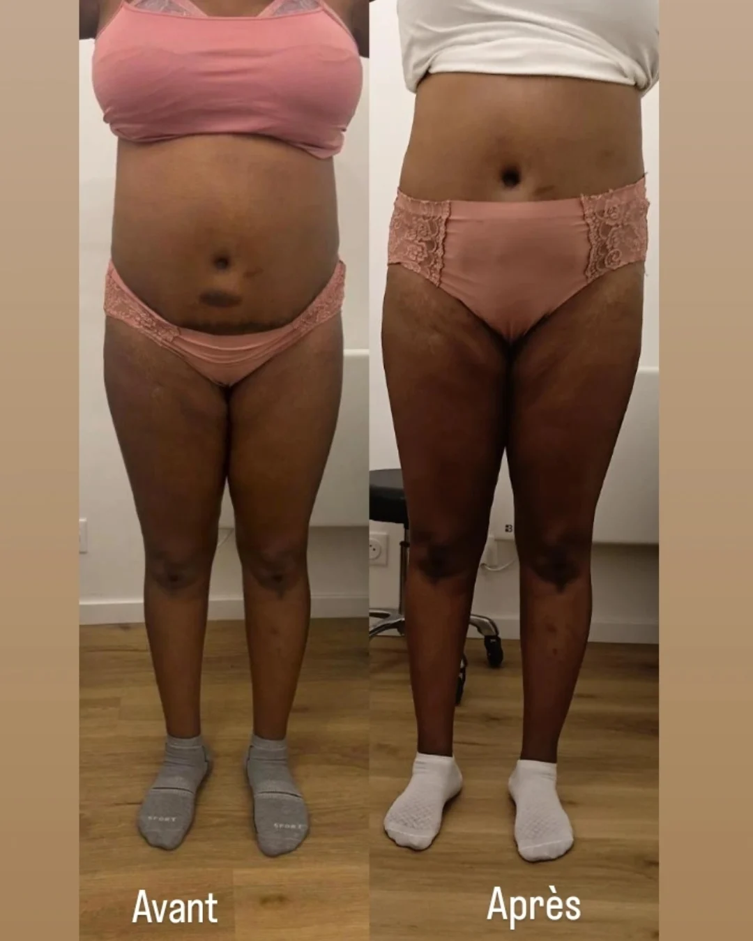 Après - Lipocavitation
